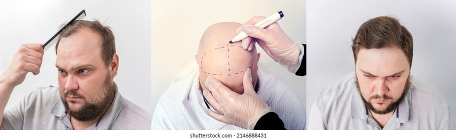 Portrait Of A Man With Baldness Problem At A Hair Transplant Operation. Cosmetic Surgery. Male Baldness Before And After Treatment. The Process Of Hair Transplantation On The Head.