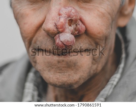 portrait of a man with cancer-basal cell carcinoma