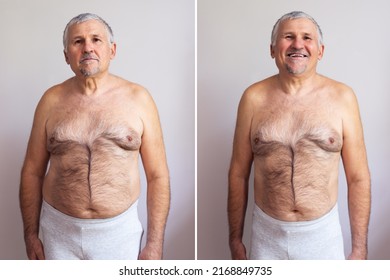 Portrait Of A Mature Man Before And After Weight Loss On White Background. Body Shape Was Altered During Retouching