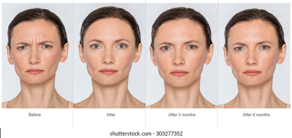 Portrait Of Middle Aged Woman Before And After Cosmetic Surgeon Or Plastic Surgery In Long Term - 3 And 6 Months After Treatment. Illustration After Lips Volume Injection, Botox, Blemishes Removal. 