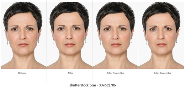 Portrait Of Middle Aged Woman Before And After Cosmetic Surgeon Or Plastic Surgery In Long Term - 3 And 6 Months After Treatment. Illustration After Lips Volume Injection, Botox, Lifting. 