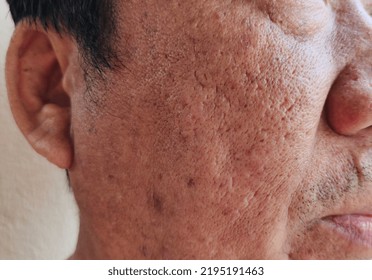 Portrait Showing The Blemish And Acne Skin On The Cheek, Dark Spots And Rough Skin, Freckles And Dermatitis On The Face, Problem Wrinkles And Flabby Skin Of The Male Patient, Concept Health Care,