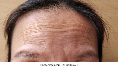 Portrait Showing The Crease Skin Of The Forehead, Problem Skin Weakness On The Face Of The Woman, Concept Health Care.