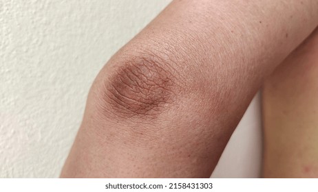 portrait showing crook of the arm, problem black elbow of the woman, concept health care. - Shutterstock ID 2158431303