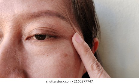 Portrait Showing The Finger Squeezing Flabbiness Cellulite Skin On The Eyelid, Problem Freckles Flabby Skin And Wrinkles Beside The Face Of The Woman, Concept Health Care.