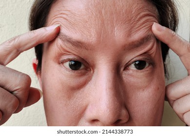 portrait showing the fingers holding the flabbiness skin on the face, problem cellulite under the eyes and ptosis on the eyelid of the woman, concept health care.