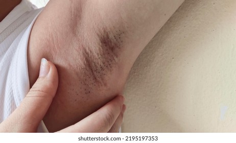 Portrait Showing The Fingers Holding The Flabbiness And Wrinkled Skin Under Arm, Problem Armpit Long Hair Underarm Of The Woman, Concept Health Care.