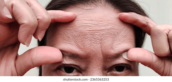 portrait showing the fingers holding the forehead lines and flabby skin, wrinkles and Flabbiness, ptosis beside the eyelid of the woman, health care and beauty concept. - Shutterstock ID 2365363253