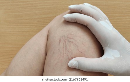 Portrait Showing The Fingers Holding The Varicose Veins On The Leg Of The Woman, Problem Circulation Of Blood, Concept Health Care.