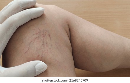 Portrait Showing The Fingers Holding The Varicose Veins On The Leg Of The Woman, Problem Circulation Of Blood, Concept Health Care.