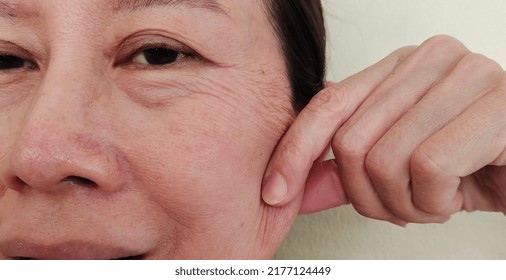 Portrait Showing The Fingers Squeezing The Flabbiness Adipose Hanging Skin Beside The Face, Flabby And Dark Spots, Wrinkle And Cellulite Under The Eyes Of The Woman, Concept Health Care.