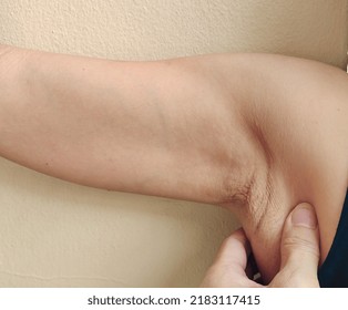 Portrait Showing The Fingers Squeezing Flabbiness Adipose Sagging Under The Arm, Wrinkled And Cellulite, Problem Armpit Hair And Rough Skin Underarm Of The Woman, Concept Health Care.