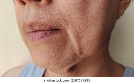 Portrait Showing The Flabbiness Adipose Sagging Skin On The Face, Cellulite Under The Eyes, Blemishes And Dark Spots, Problem Wrinkled And Flabby Skin Of The Middle-aged Woman, Concept Health Care.