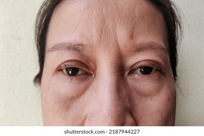 Portrait Showing The Flabbiness Adipose Sagging Skin Under The Eyes, Forehead Lines On The Face, Sadness Worried Of The Lady, Problem Wrinkles And Dark Spots Of The Woman, Concept Health Care.