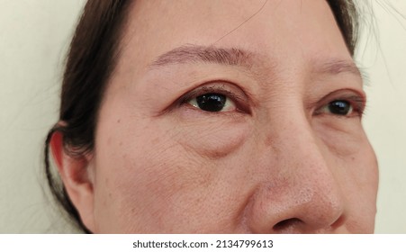 portrait showing flabbiness skin under the eyes, problem ptosis on the eyelid of the woman, concept health care.