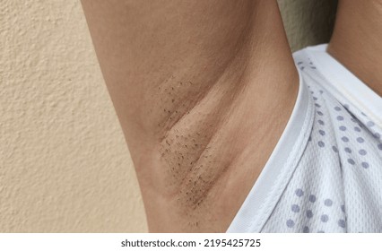 Portrait Showing The Flabbiness And Wrinkled Skin Under Arm, Chicken Skin And Lines, Problem Armpit Long Hair Underarm Of The Woman, Concept Health Care.