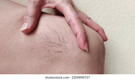 Portrait Showing The Hand Touching The Flabbiness Skin And Varicose Veins On The Leg, Circulation Of Blood, Problem Wrinkle And Flabby Skin And Inflammation Of The Patient Woman, Concept Health Care.