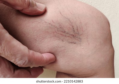 Portrait Showing The Hand Touching The Flabbiness Skin And Varicose Veins On The Leg, Circulation Of Blood, Problem Wrinkle And Flabby Skin And Inflammation Of The Patient Woman, Concept Health Care.