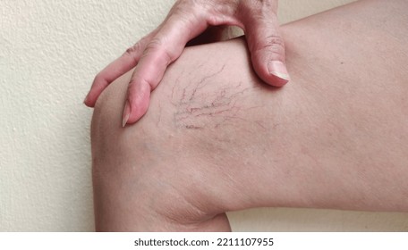 Portrait Showing The Hand Touching The Flabbiness Skin And Varicose Veins On The Leg, Circulation Of Blood, Problem Wrinkle And Flabby Skin And Inflammation Of The Patient Woman, Concept Health Care.