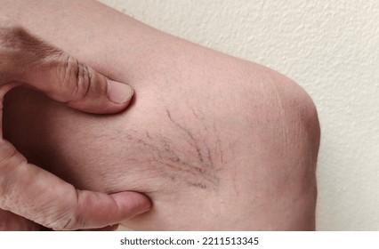 Portrait Showing The Hand Touching The Flabbiness Skin And Varicose Veins On The Leg, Circulation Of Blood, Problem Wrinkle And Flabby Skin And Inflammation Of The Patient Woman, Concept Health Care.