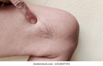 Portrait Showing The Hand Touching The Flabbiness Skin And Varicose Veins On The Leg, Circulation Of Blood, Problem Wrinkle And Flabby Skin And Inflammation Of The Patient Woman, Concept Health Care.