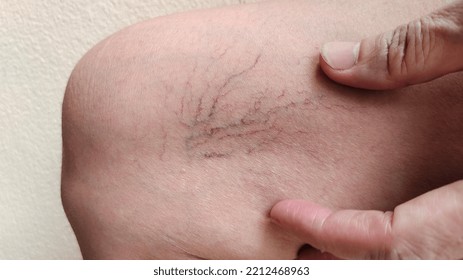 Portrait Showing The Hand Touching The Flabbiness Skin And Varicose Veins On The Leg, Circulation Of Blood, Problem Wrinkle And Flabby Skin And Inflammation Of The Patient Woman, Concept Health Care.