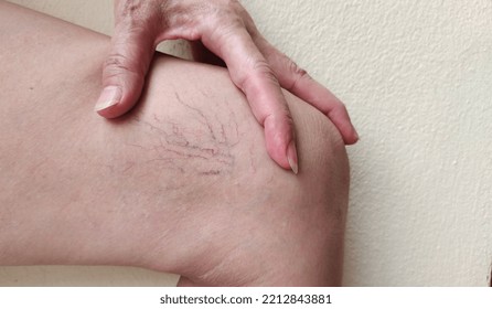 Portrait Showing The Hand Touching The Flabbiness Skin And Varicose Veins On The Leg, Circulation Of Blood, Problem Wrinkle And Flabby Skin And Inflammation Of The Patient Woman, Concept Health Care.