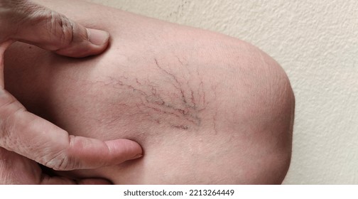 Portrait Showing The Hand Touching The Flabbiness Skin And Varicose Veins On The Leg, Circulation Of Blood, Problem Wrinkle And Flabby Skin And Inflammation Of The Patient Woman, Concept Health Care.