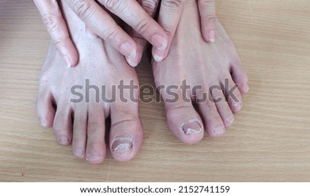 portrait showing infection of toenail fungus, problem pedicure and ingrown toenail of the woman, concept health care.