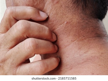 Portrait Showing Inflammatory Acne On The Neck, Blemishes And Dullness, Rough Skin And Dark Spots, Problem Scratching Rash, Hives On The Body Of The Male Patient, Concept Health Care.