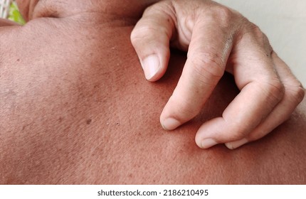 portrait showing Inflammatory acne on the body, blemishes and dullness, rough skin and dark spots, problem scratching rash, hives on the body of the male patient, concept health care. - Shutterstock ID 2186210495