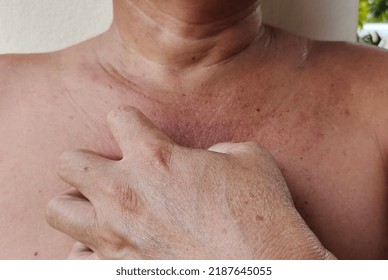 Portrait Showing Inflammatory Acne On The Body, Blemishes And Dullness, Rough Skin And Dark Spots, Problem Scratching Rash, Hives On The Body Of The Male Patient, Concept Health Care.