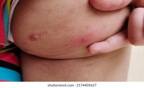 Portrait Showing Inflammatory Acne Treatment, Problem Sin Disease Of The Woman, Concept Health Care.