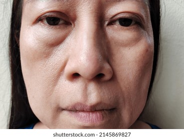 Portrait Showing Problems Adipose And Cellulite On The Face, Flabbiness On The Skin Beside The Mouth Of Middle-aged Woman, Concept Health Care.