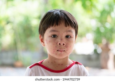 Portrait of sick little  boy. Varicella virus or Chickenpox bubble rash on child