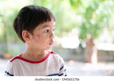 Portrait of sick little  boy. Varicella virus or Chickenpox bubble rash on child