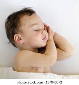 Portrait Of A Sleeping Child With Red Spots On His Skin Of Chicken Pox.