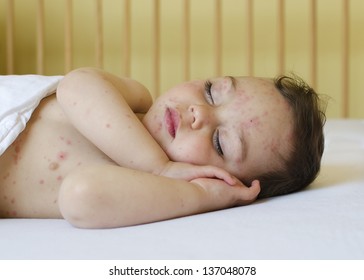 Portrait Of A Sleeping Child With Red Spots On His Skin Of Chicken Pox.