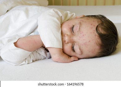 Portrait Of A Sleeping Child With Red Spots On His Skin Of Chicken Pox. 