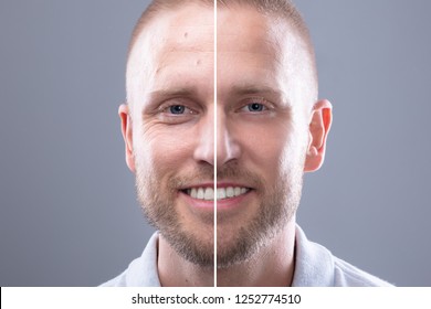 Portrait Of A Smiling Man's Face Before And After Cosmetic Procedure On Grey Background