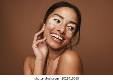 Portrait Of Smiling Woman Having Vitiligo On Face. Close Up Of Happy Woman With Skin Problem On Brown Background.