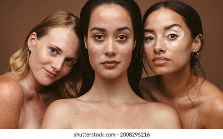 Portrait Of Smiling Women With Skin Issues Together On Brown Background. Women With Diverse Skin Types Seem Confident And Undisturbed.