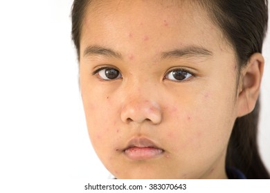 Portrait Of Teen To Unhappy With Chicken Pox On Face
