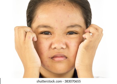 Portrait Of Teen To Unhappy With Chicken Pox On Face
