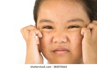 Portrait Of Teen To Unhappy With Chicken Pox On Face
