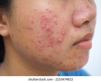 Portrait of ugly teenage girl having problems of acne inflammation on her face. concept of facial care products. closeup photo, blurred. - Shutterstock ID 2153474813