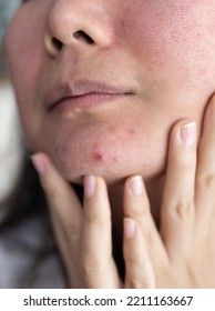 Portrait of ugly teenage girl having problems of acne inflammation on her face. concept of facial care products. closeup photo, blurred. - Shutterstock ID 2211163667