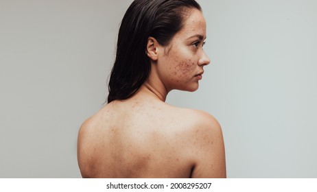 Portrait Of Woman Having Acne Inflammation On Face And Body. Rear View Close Up Of Woman With Pimples On Face.