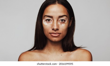 Portrait Of Woman With Vitiligo. Close Up Of Woman With Skin Condition