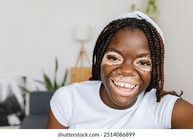 Portrait of young african woman with vitiligo smiling at camera relaxing on sofa at home - Powered by Shutterstock